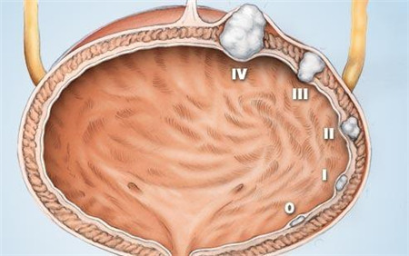 膀胱壁长期慢性的局部刺激,如长期慢性感染,膀胱结石的长期刺激以及尿