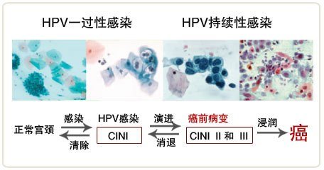 HPV感染过程