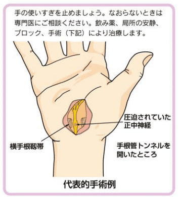 日本手术治疗腕管综合征