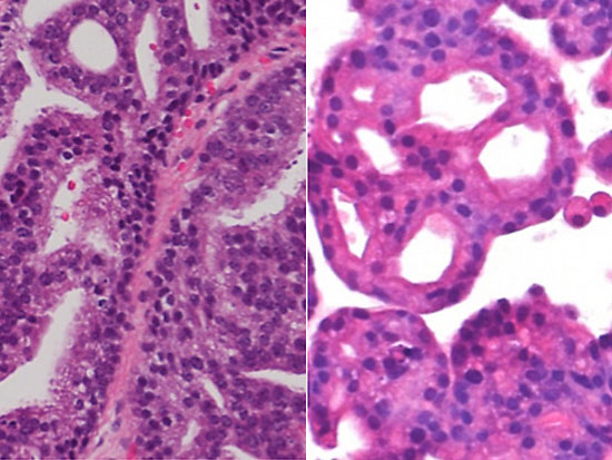 Cell：科学家初次培育出癌症类器官