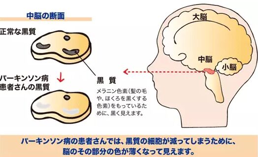 阿尔茨海默病