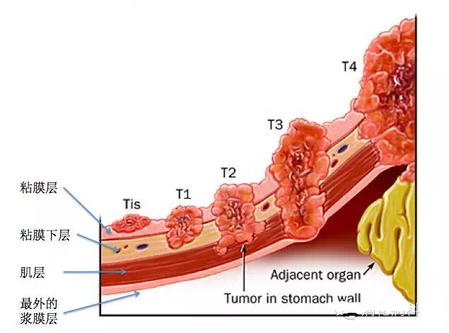 隨著腫瘤生長,會浸潤粘膜下層,肌層,突破漿膜層以及發生淋巴結轉移和