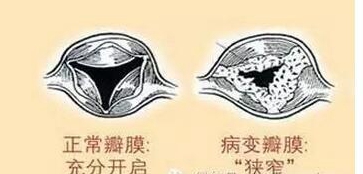 日本心脏瓣膜手术