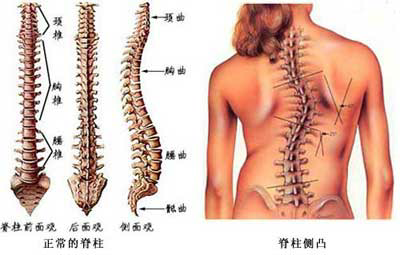 日本治疗脊柱侧弯