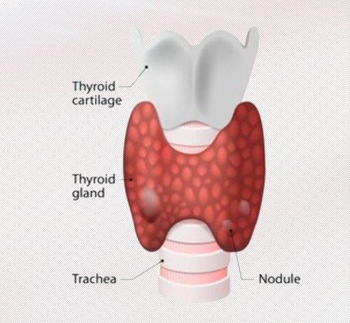 美国治疗甲状腺肿瘤