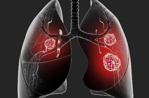 美国看病,美国肺癌