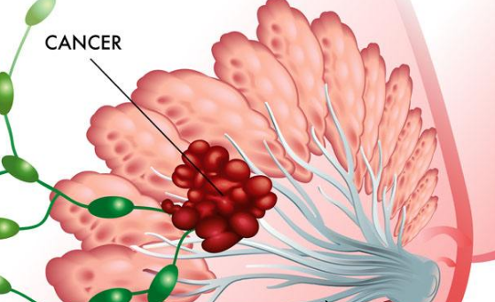 美国治疗乳腺癌