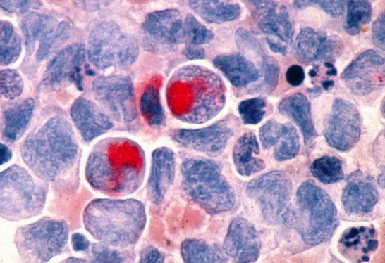 美国治疗白血病