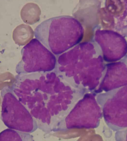 美国治疗白血病