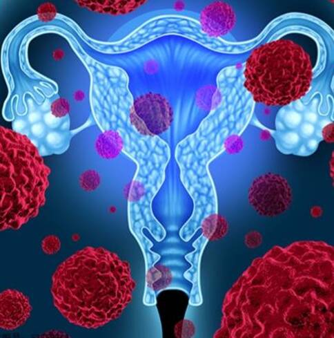 美国看病,美国子宫癌