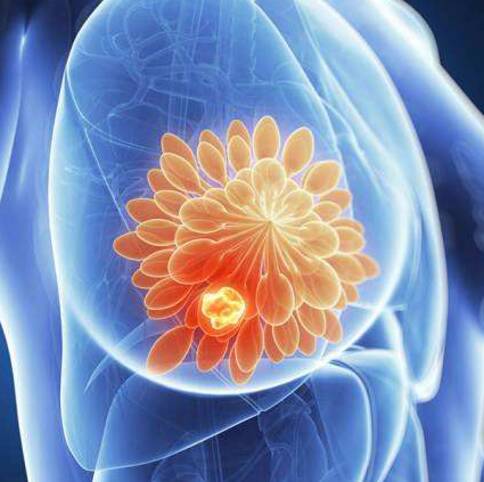 美国看病,美国乳腺癌