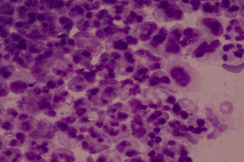 更高剂量的舒尼替尼具有细胞毒性能够降低MCL-1表达水平