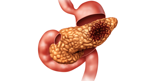 胰腺癌出国治疗：真菌微生物与胰腺导管腺癌的发生具有密切联系！