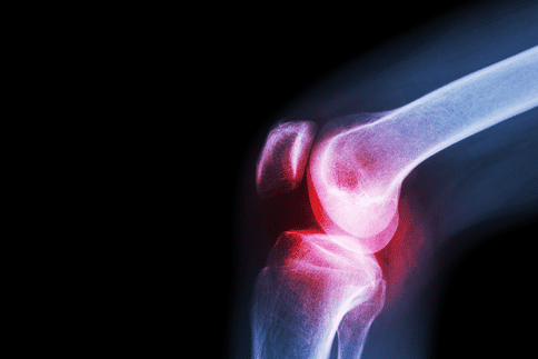 出国看病:美国发现了痛风治疗的新方法,或可帮助痛风患者控制疾病