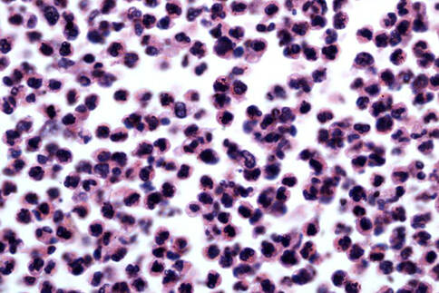 白细胞抗原越多癌症免疫治疗方法效果越好