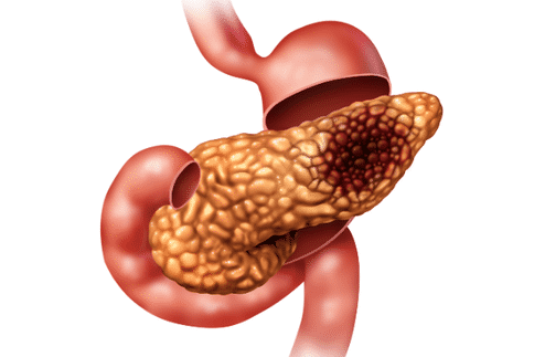 胰腺癌为什么难以治疗?