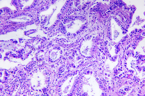 治疗前列腺癌骨转移的新研究