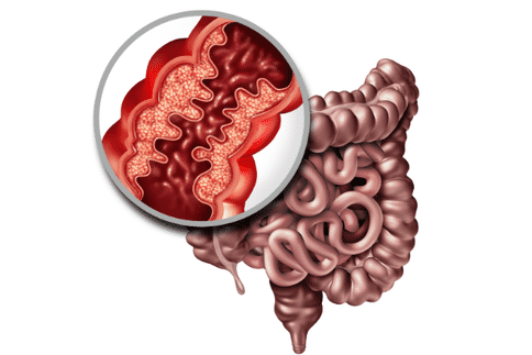 研究发现计算机辅助成像技能可以提供更加准确的大肠癌诊断!