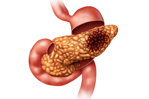 研究揭示调节性T细胞在胰腺癌中的作用,胰腺癌新治疗方法指日可待!