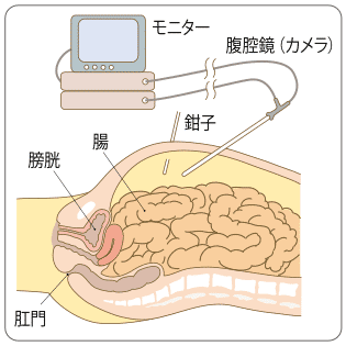 日本早期结直肠癌治疗