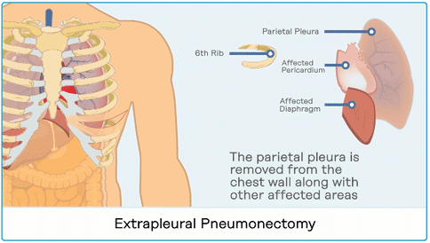 胸膜间皮瘤手术治疗