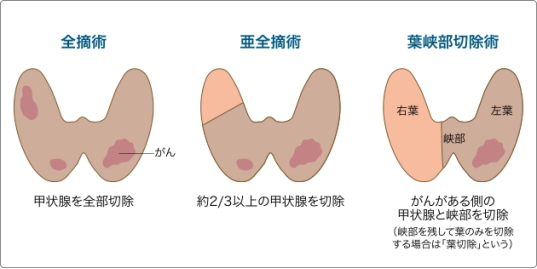 甲状腺乳头状癌治疗