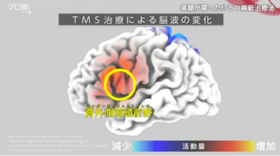 抑郁症治疗方法