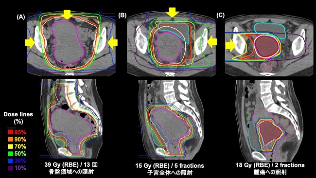 宫颈癌治疗方法