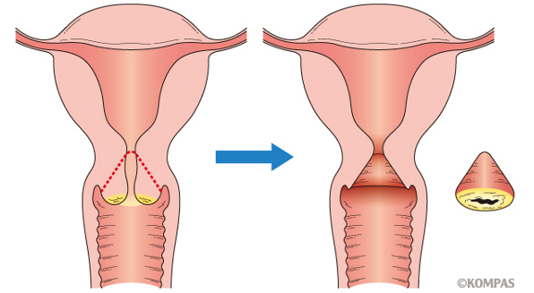 宫颈癌治疗方法 宫颈癌治疗方法