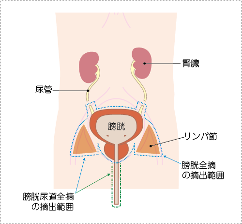 日本治疗膀胱癌