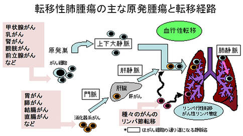 转移性肺癌治疗