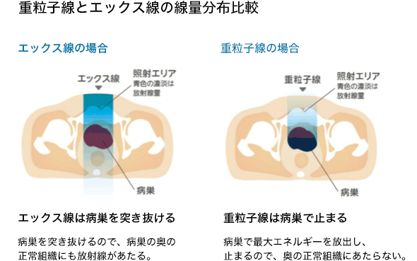 重离子放疗优势