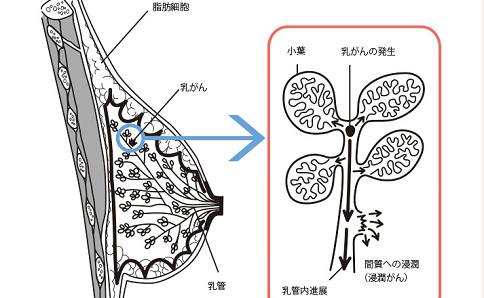 日本治疗乳腺癌医院排名