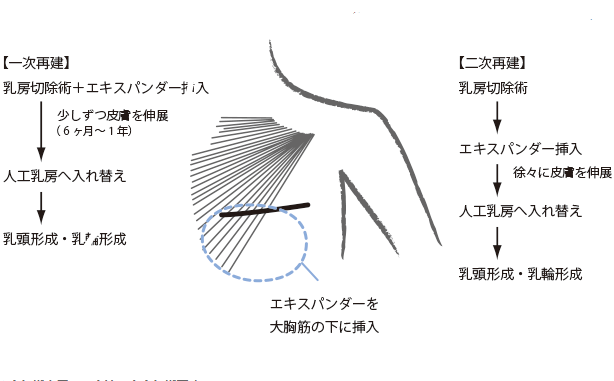 乳腺癌乳房重建术