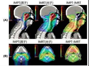 鼻咽癌质子治疗