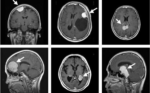 治疗脑胶质瘤哪家医院好 治疗脑胶质瘤哪家医院好