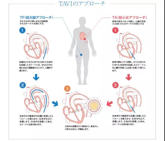 心脏瓣膜疾病