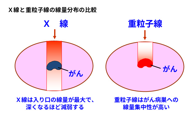 重离子治疗骨肉瘤特点