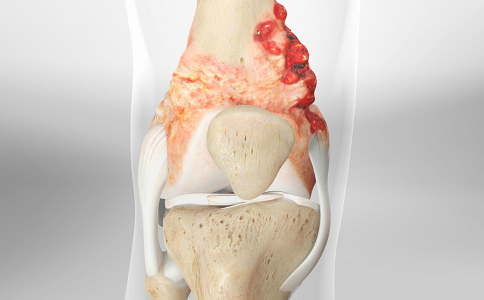 早期骨肉瘤治疗 早期骨肉瘤治疗