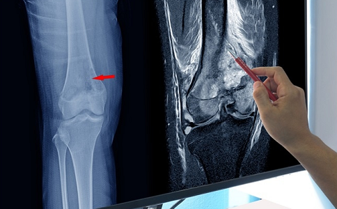骨肉瘤复发治疗方法 骨肉瘤复发治疗方法