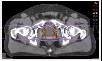 重离子治疗前列腺癌效果