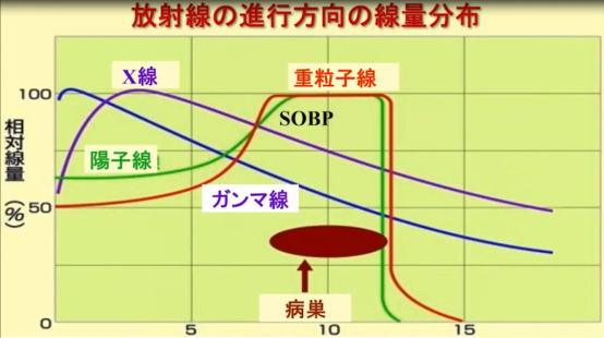 腺样囊性癌重离子治疗