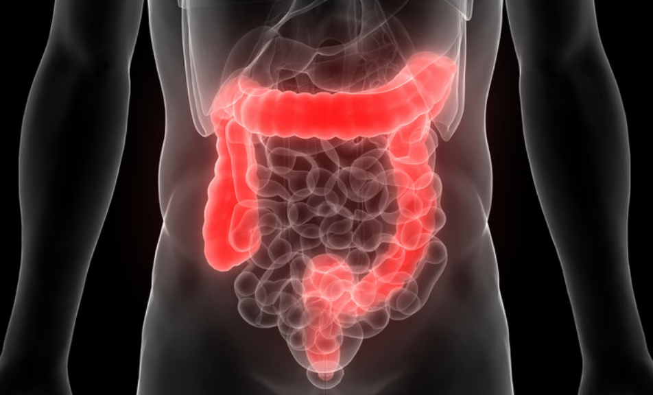 晚期结肠癌治疗 晚期结肠癌治疗