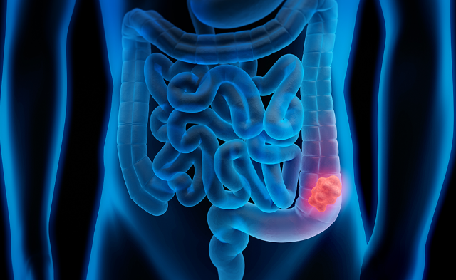 KRAS结肠癌靶向治疗 KRAS结肠癌靶向治疗