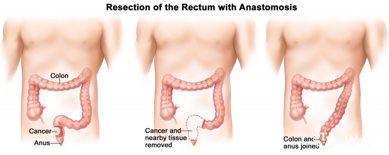 结肠癌直肠癌手术治疗 结肠癌直肠癌手术治疗
