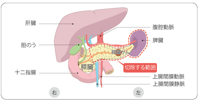 胰腺癌手术治疗