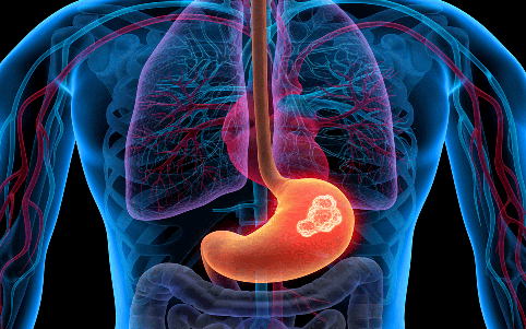 胃癌晚期日本看病 胃癌晚期日本看病